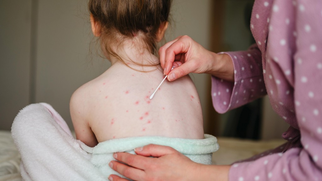 Auf dem Rücken eines Kindes ist der Ausschlag von Windpocken zu sehen. Die Mutter trägt ein Gel auf.
