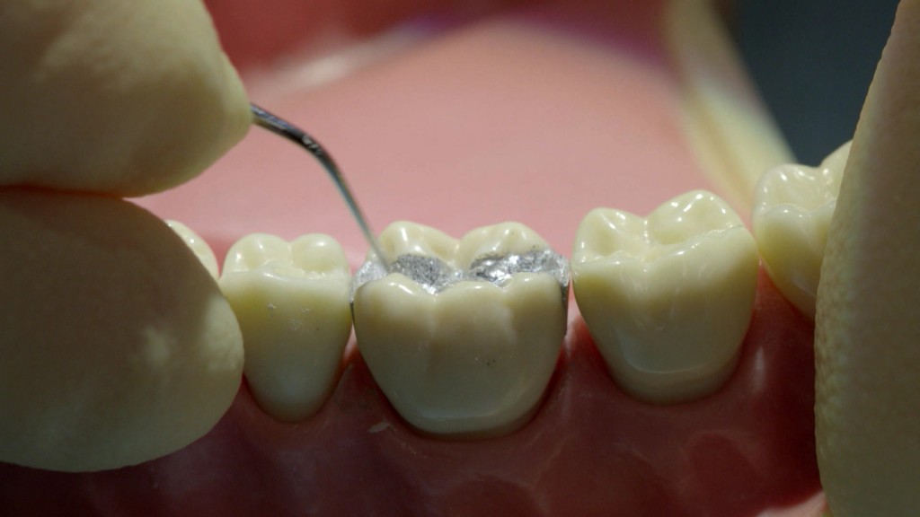 Foto: Zähne mit Amalgam-Füllung