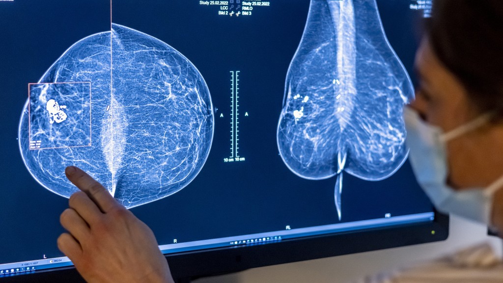 Medizinisches Personal untersucht mit einer Mammografie die Brust einer Frau auf Brustkrebs. 
