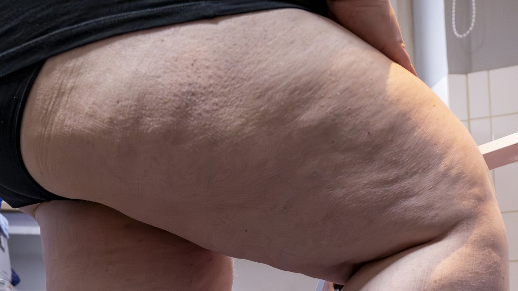 Eine Frau, die an einem Lipödem leidet, zeigt ihre Oberschenkel