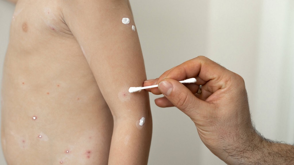 Foto: Ein Kind wird mit Salbe gegen Hautausschlag behandelt