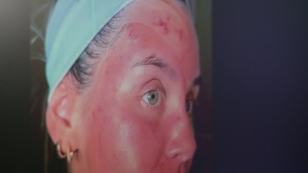Foto: Nach Microneedling ist die Haut stark gerötet.